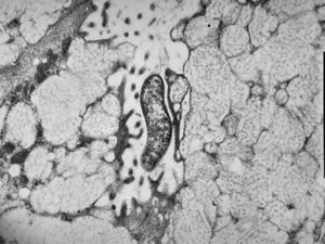 M,82y. | Helicobacter pylori - antrum pylori M,82y. | Helicobacter pylori - antrum pylori